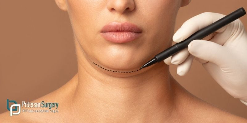 Double Chin Surgery: How to Achieve a More Defined Chin and Neck Area